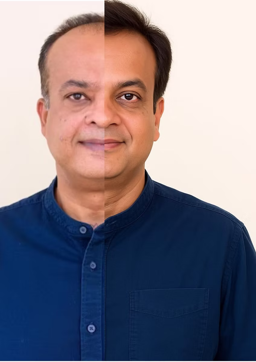 Hair transplant patient with a natural looking hairline