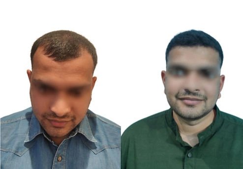 Hair transplant result at Dr. Vivek Gupta clinic