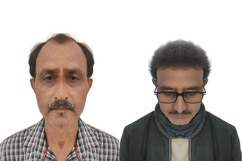 Hair transplant result at Dr. Vivek Gupta clinic