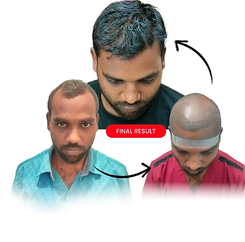 Hair transplant result at Dr. Vivek Gupta clinic
