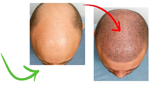 Hair transplant result at Dr. Vivek Gupta clinic