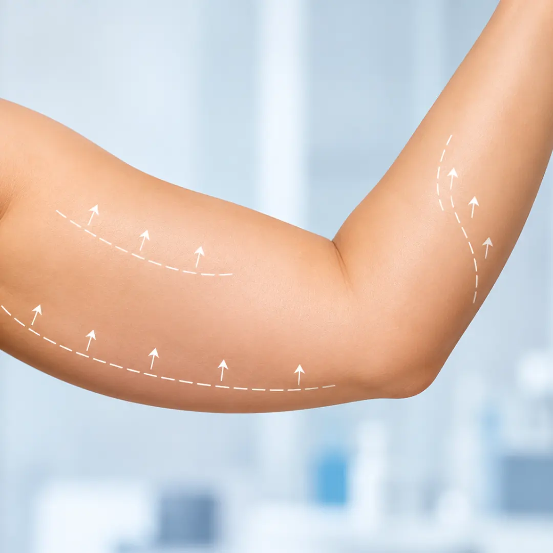 Liposuction contouring marks on the upper arm