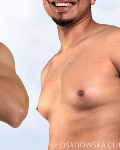 Gynecomastia