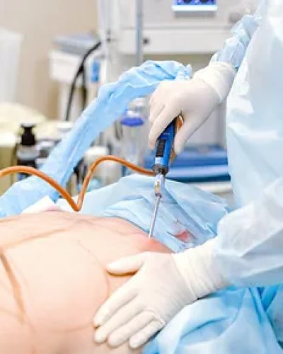 Liposuction