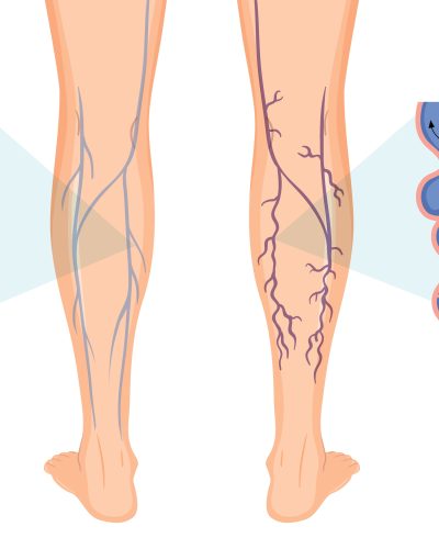 Varicose Vein