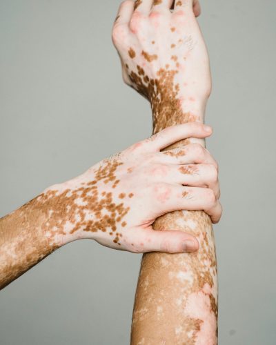 Vitiligo Surgery