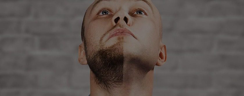 Beard Implant - Dr. Vivek Gupta's Clinic, Lucknow