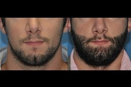 Beard implant procedure at Dr. Vivek Gupta's Clinic, Lucknow