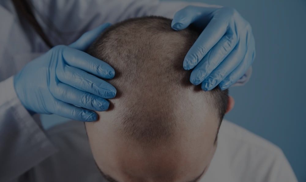 Hairline Reconstruction - Dr. Vivek Gupta's Clinic, Lucknow