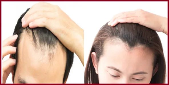 Hairline reconstruction at Dr. Vivek Gupta's Clinic, Lucknow