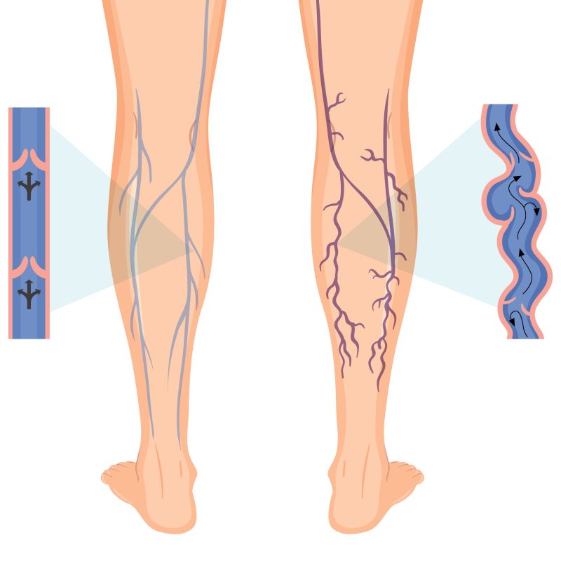 Varicose veins laser treatment at Dr. Vivek Gupta's Clinic, Lucknow